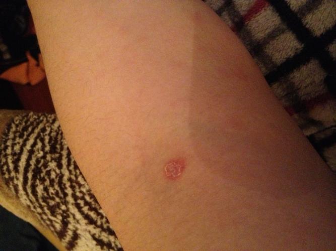 好几天了,胳膊周围的皮肤下面有隐隐的红疹,这是艾滋病皮疹吗?