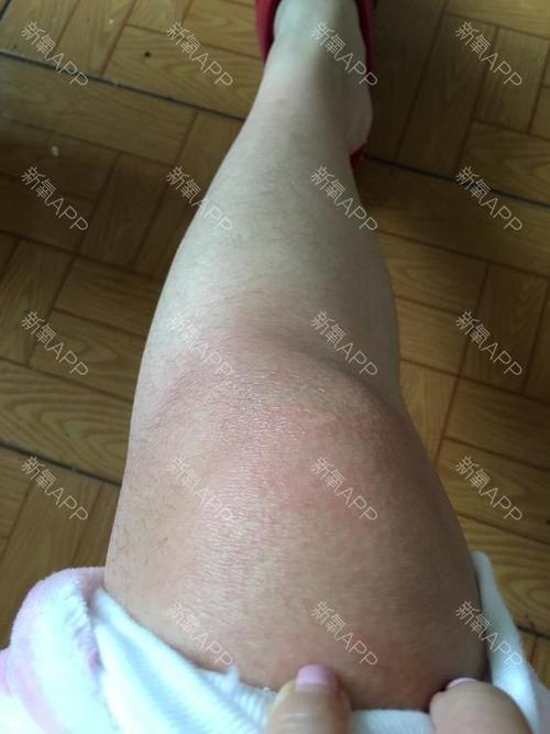 对克林霉素过敏,两天了,还没消肿,我还要不要去医院