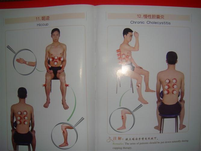 【转载】拔罐图解