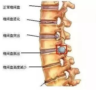 每次10~15分钟,此方法是广大患者推荐的一种腰椎间盘突出症的锻炼方法