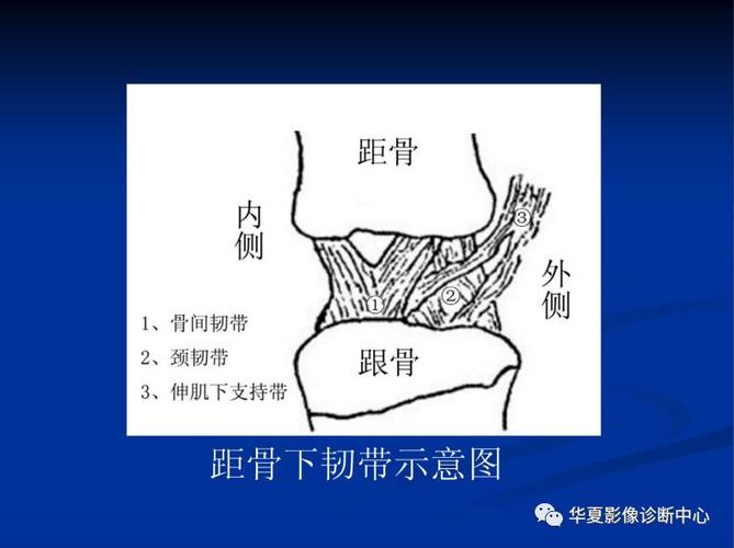 跗骨窦综合征