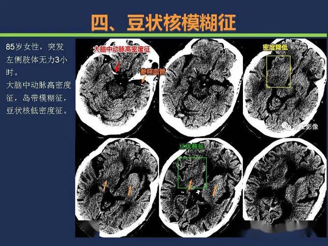 汇总| 超早期脑梗死ct征象