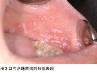口腔念珠菌病(oral  candidiasis)是念珠菌属真菌引起的口腔黏膜感染