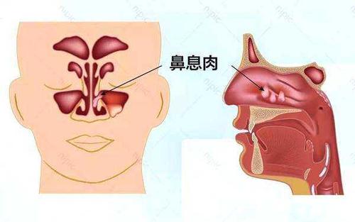 想知道洗鼻的功效,首先要知道在鼻炎情况下,鼻子内部构造是怎么样的