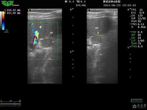副脾- 超声医学讨论版 - 爱爱医医学论坛 - 爱爱医医学网