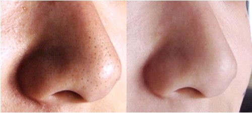 小小牙签棒大用处,如何利用牙签棒高效去黑头!