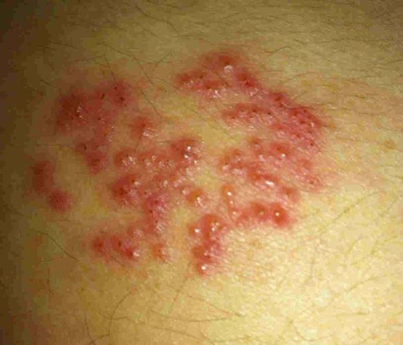 求救,这是什么,疱疹还是什么东西,一开始就是很痛,长在背部,前面皮肤