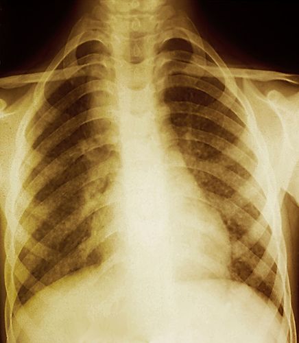 肺图片_肺图片大全_全景图片