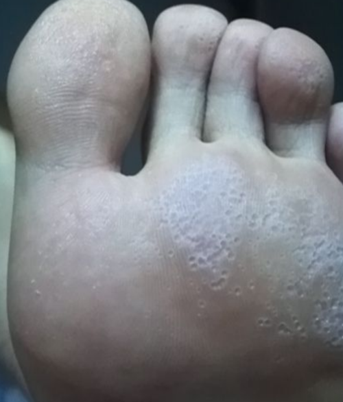 足藓图片和症状