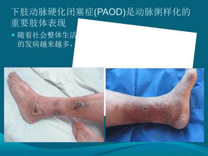 下肢动脉硬化闭塞症护理查房
