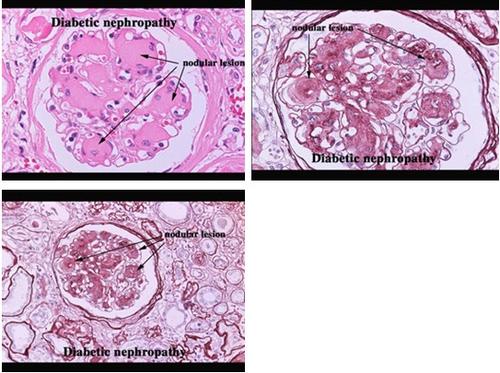 下列哪各项中为糖尿病肾病高度特异性病理改变的是()