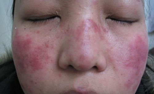 系统性红斑狼疮女性能否怀孕?医生:时机很关键