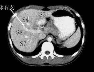 肝脏ct分段