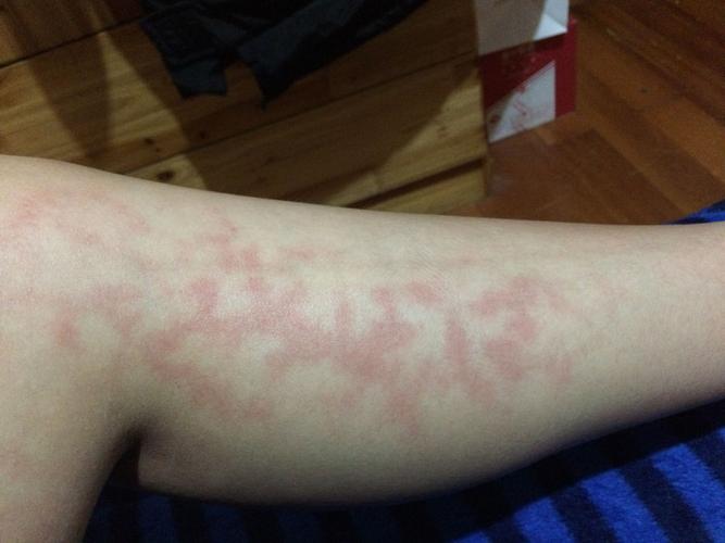 腿上出现红斑不痛不痒,好像几个月了,这个冬天有的也没在意,最近感觉