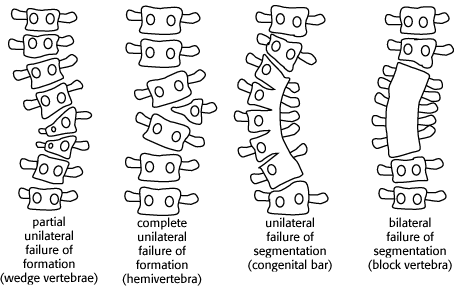 先天性脊柱侧弯何时是最好的手术时机