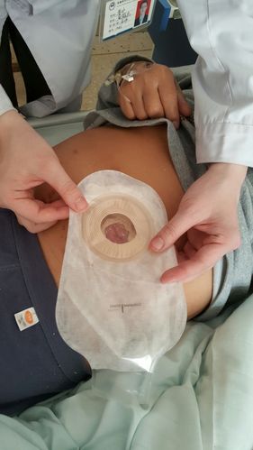 即经腹会阴直肠癌根治切除术,行直肠及肛门切除,结肠造口(人工肛门)