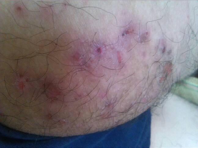 朋友屁股长疮,部分溃烂 现在就成图片这样,请问这是什么病 该如何治疗