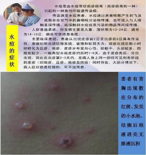 致家长的一封信——预防冬春季水痘传染病