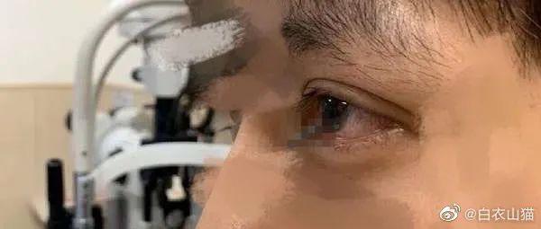 眼睛扎入异物后现场该如何正确处理