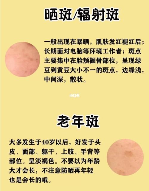 祛斑小知识_祛斑_妊娠斑_淡斑_晒斑_雀斑_祛斑淡斑_美妆_护肤