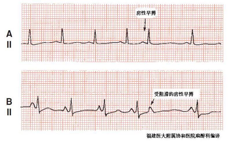 解读临床心电图:形成,诊断及临床意义(下)