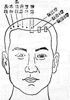 朱氏头皮针示意图-医海之星2:传统医药:针灸按摩保健:1针灸学 :3刺灸
