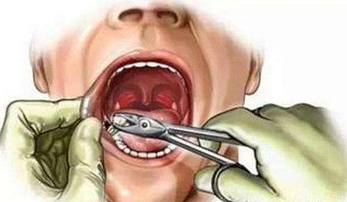 拔牙后要不要缝针的