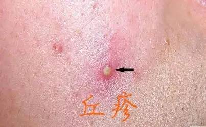 一般丘疹就是堵在毛孔的角栓油脂混合物发炎导致的.