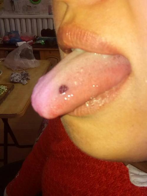 舌头上起了个紫红泡是怎么回事啊?