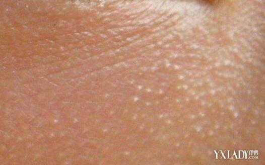 护肤 问题肌肤 正文 判断 眼周白色小颗粒≠脂肪粒 其实,这些长在上下