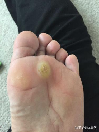 长出来了,就自己修薄了.之前一年半前,医生用液氮治过,但是没好.