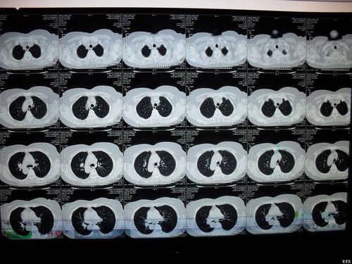 请大家帮忙看一ct片谢谢