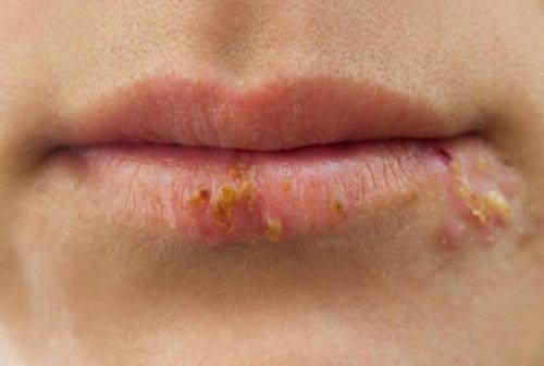 嘴巴老是生疮上火该咋办3个小方法来帮您尽管较土可是管用