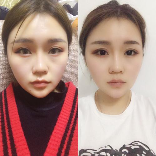 啦啦啦～ 终于打完了第三支溶脂针,给我做微整的小姐姐告诉我说这