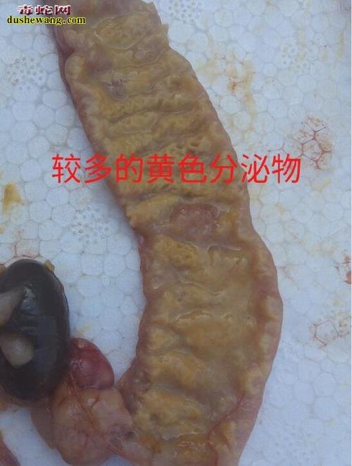 肠道黏膜增厚异常