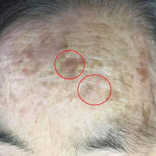 认识容易恶变的老年斑日光性角化病