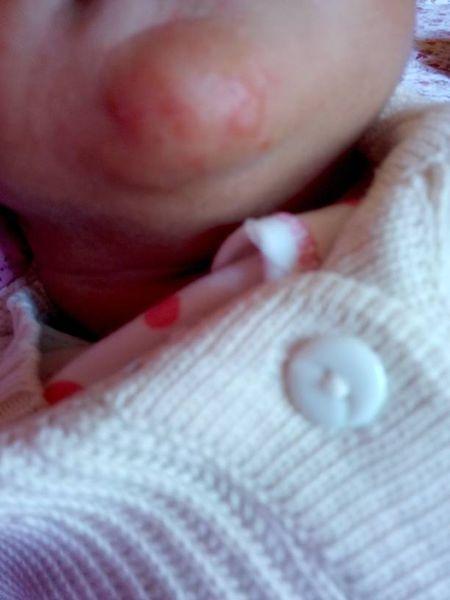 问:宝宝下巴这是奶鲜还是湿疹!求医生答解…急