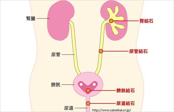 预防泌尿系结石主要措施