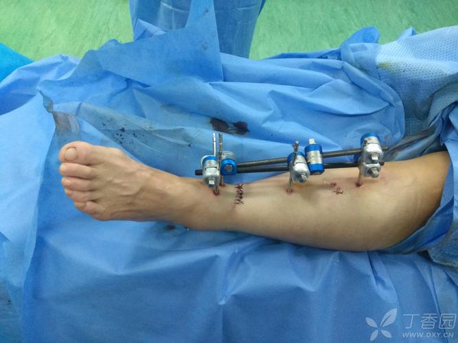 小医-胫骨开放骨折,外架固定1例
