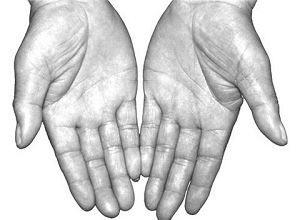 癌症-肿瘤 癌症资讯  因结肠癌手术在恢复期.