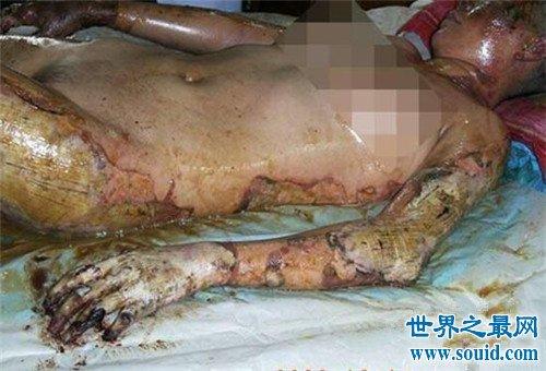 九州世界之最 娱乐之最任家萱烧伤图片一直都是粉丝们的痛,selina