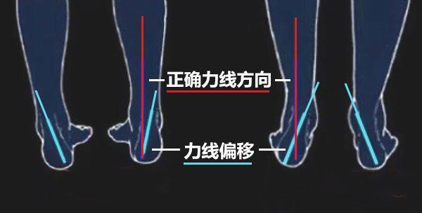 多多少少都出现了足踝不正(足内翻/足外翻等),骨盆歪斜等情况,而这些