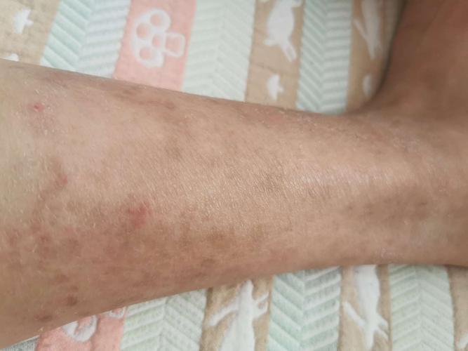 腿上的红斑有点烂被狗舔了有事么