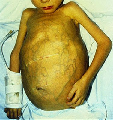 肝门静脉; 药物不可能治愈肝硬化; 外科学