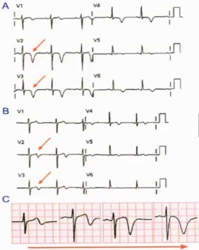 图文详解,冠心病心肌缺血的特异心电表现
