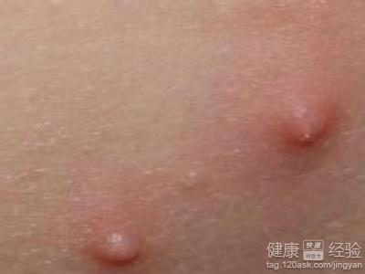 了孩子的左边阴囊上有三个很小的痘一样的形状是圆的3mm大小(米粒大小