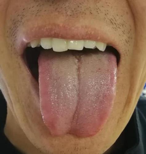 肝火旺盛看舌边看舌边