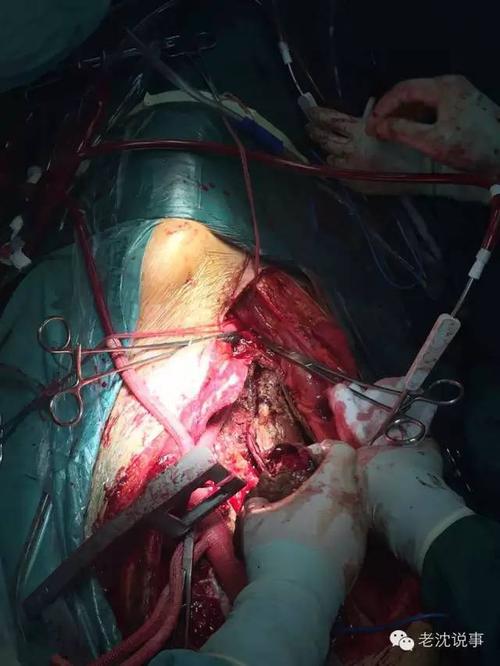 若生之有望,一米伤口又如何?