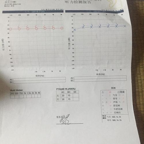 分泌性中耳炎2个多月了,复查听力已经正常了,请问为什么声导抗测听