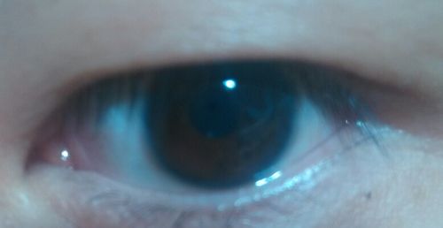 眼睛泪阜那是不是长了什么东西,还是什么,泪阜不是就那一点的吗,怎么